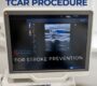 TCAR PRocedure West Florida Vascular and Vein 90x80