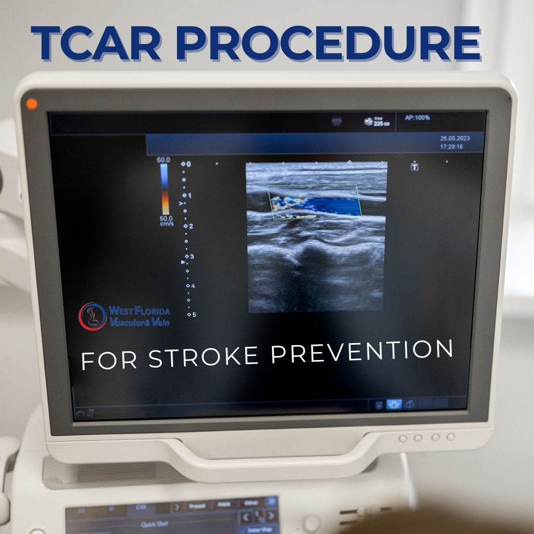 TCAR Procedure West Florida Vascular and Vein