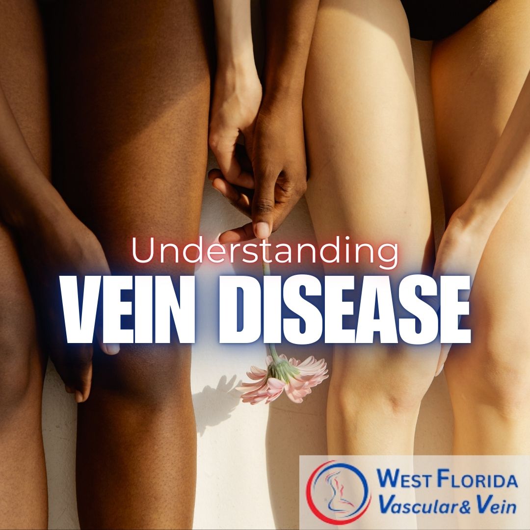 Understanding Vein Disease symptoms West Florida vascular and vein